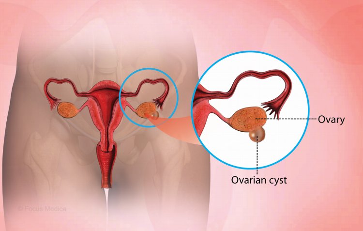 6 Ovarian Cyst Symptoms for Early Detection in Women