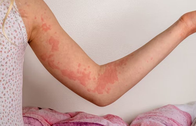 10 Common Skin Rash Causes and How to Avoid Them