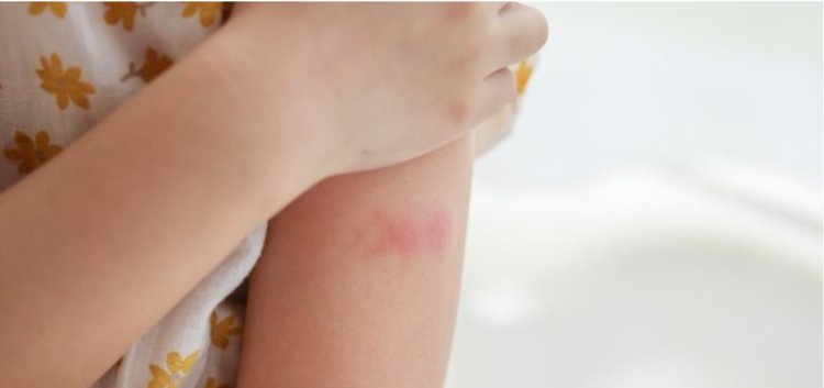 Understanding Eczema: An Overview