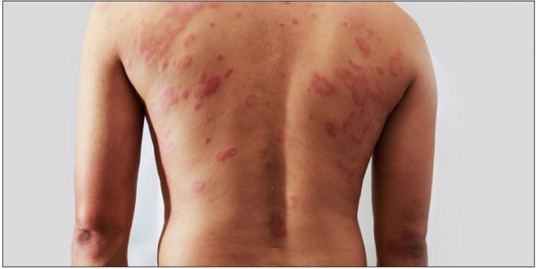 Causes and Risk Factors of Eczema