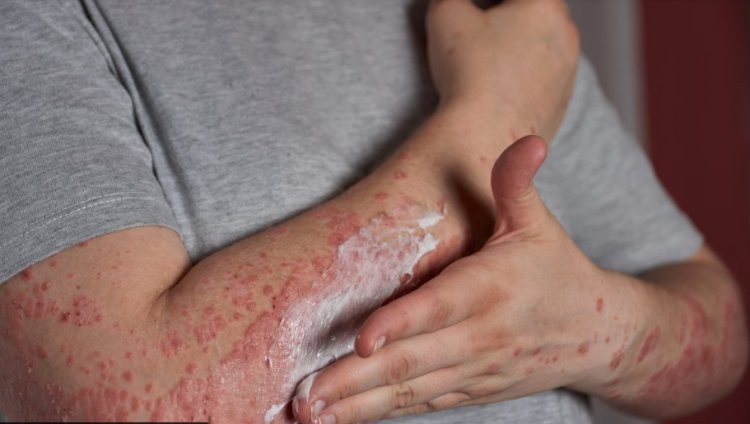 Common Symptoms and Signs of Eczema