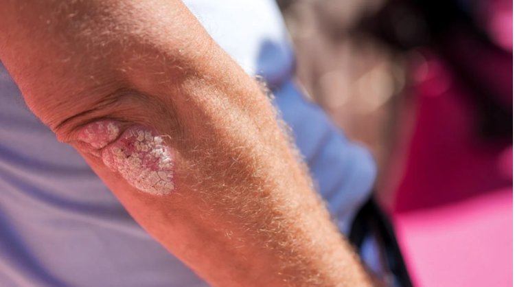 Understanding Psoriasis: An Overview