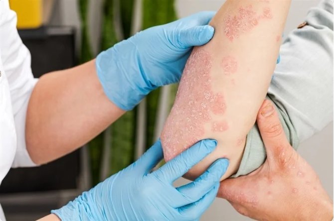 Common Symptoms and Signs of Psoriasis