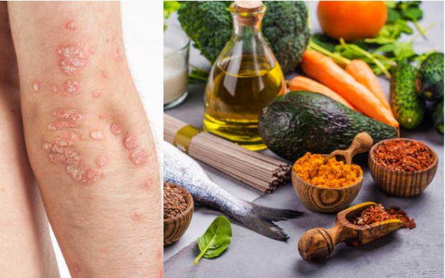 The Role of Diet and Nutrition in Managing Psoriasis