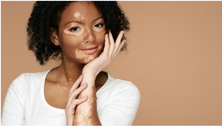 Understanding Vitiligo: An Overview