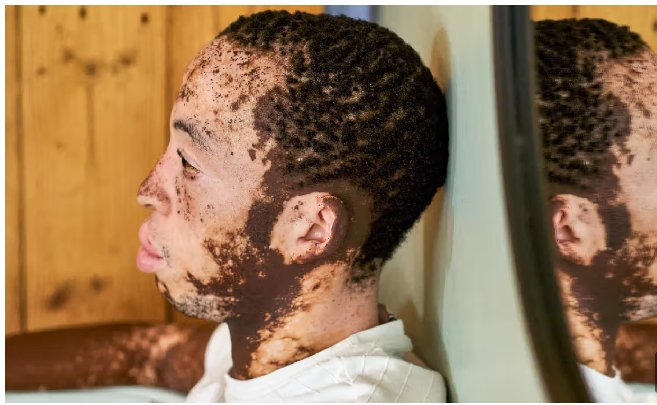 Common Symptoms and Signs of Vitiligo