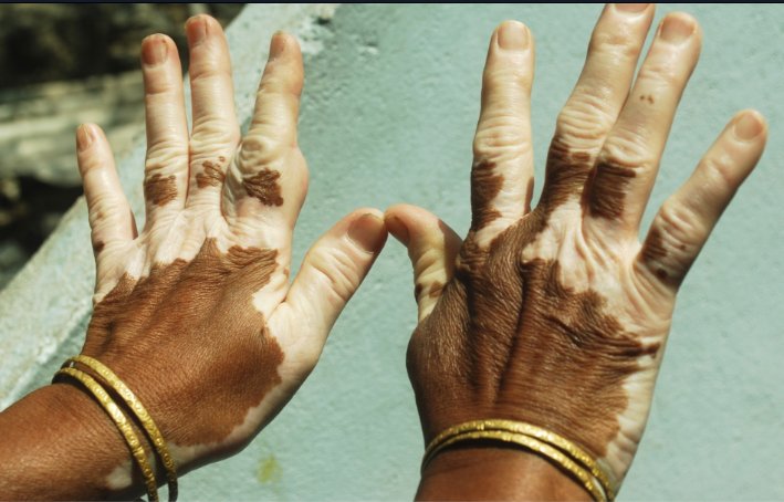 Managing Vitiligo Flare-Ups: Tips and Strategies