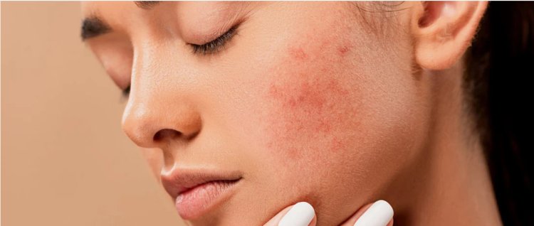 Understanding Rosacea: An Overview