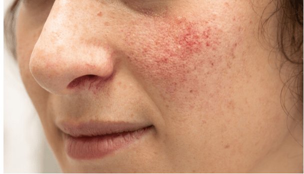 Causes and Risk Factors of Rosacea