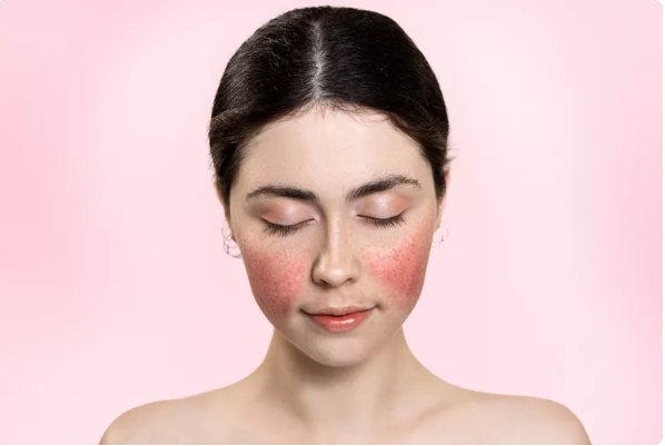 Common Symptoms and Signs of Rosacea