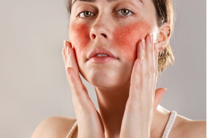 Managing Rosacea Flare-Ups: Tips and Strategies