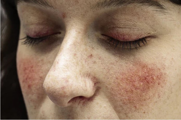 Rosacea in Different Age Groups: From Children to Adults