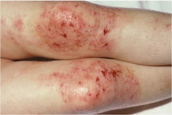 Understanding Dermatitis: An Overview