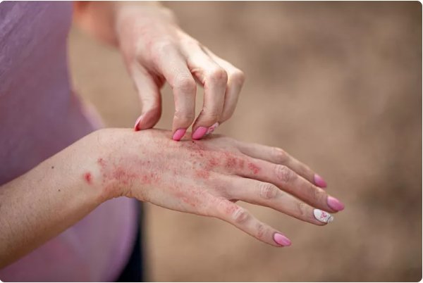 Causes and Risk Factors of Dermatitis