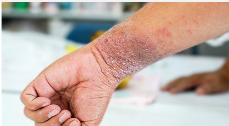 Common Symptoms and Signs of Dermatitis