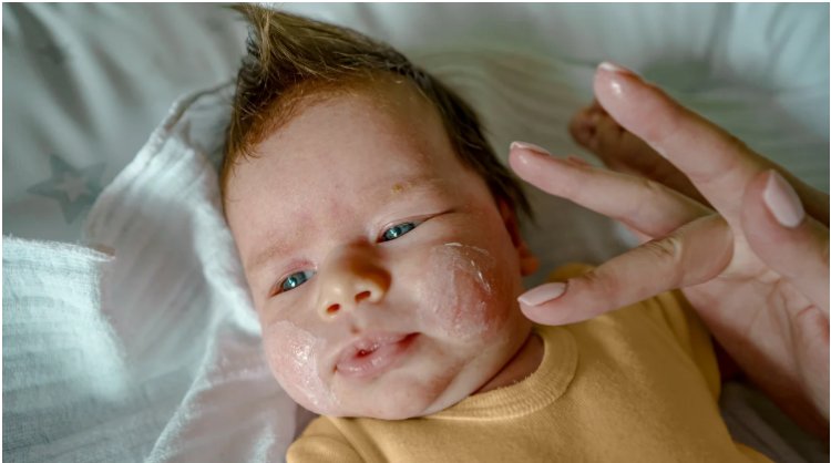 Dermatitis in Different Age Groups: From Infants to Adults